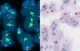 In situ hybridization centromeric probes - Molecular cytogenetics - Chromosome Enumeration