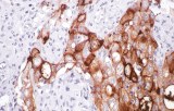 Anti-CA-125 CE/IVD for IHC - Gynecological pathology