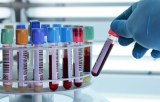 Direct PCR on blood samples