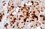 Anti-Mammaglobin CE/IVD for IHC - Gynecological pathology