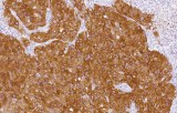 Anti-MART-1 (Melan A) CE/IVD for IHC - Dermopathology