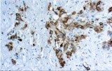 Anti-Mesothelin CE/IVD for IHC - Pulmonary pathology