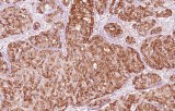 Anti-MUC1 CE/IVD for IHC - Gastrointestinal pathology