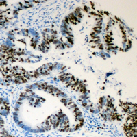 Immunohistochemical analysis of Lamin A/C (Phospho-S392) staining in human colon cancer formalin fixed paraffin embedded tissue section. The section was pre-treated using heat mediated antigen retrieval with sodium citrate buffer (pH 6.0). The section was then incubated with the antibody at room temperature and detected using an HRP conjugated compact polymer system. DAB was used as the chromogen. The section was then counterstained with haematoxylin and mounted with DPX.