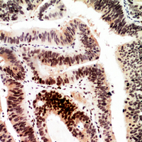 Immunohistochemical analysis of Histone H2A staining in human colon cancer formalin fixed paraffin embedded tissue section. The section was pre-treated using heat mediated antigen retrieval with sodium citrate buffer (pH 6.0). The section was then incubated with the antibody at room temperature and detected using an HRP conjugated compact polymer system. DAB was used as the chromogen. The section was then counterstained with haematoxylin and mounted with DPX.