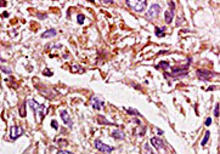 HMGA2 staining in ovary carcinoma. Formalin-fixed paraffin-embedded human ovary carcinoma tissue is stained with HMGA2 Antibody (Cat. No. 251205) used at 1:200 dilution.