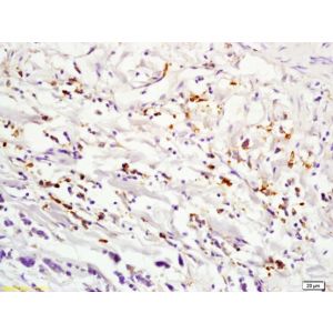Human lung carcinoma