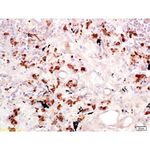 Human lung carcinoma