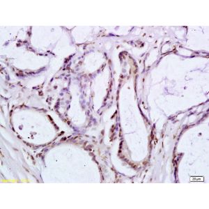Human colon carcinoma