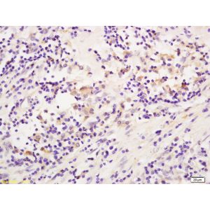 Human colon carcinoma