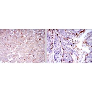 Human breast cancer tissues (left) and human esophageal cancer tissues (right)