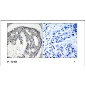 Human breast carcinoma