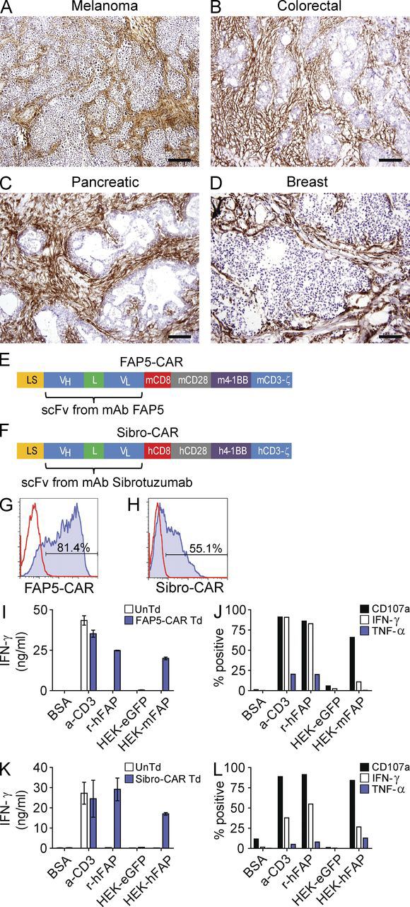 Figure 2 IHC staining for FAP in various human tumors, and design and in vitro activity of FAP-reactive CARs.