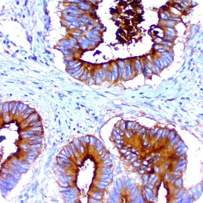 histology of malignant mesothelioma