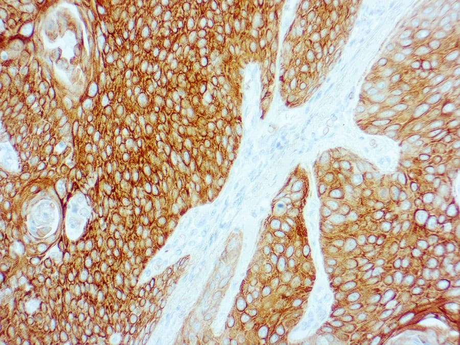 pleural mesothelioma and diagnosis